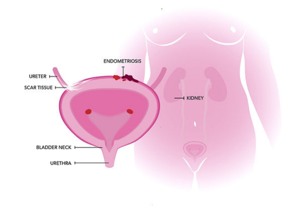 Symptoms_of_Endometriosis