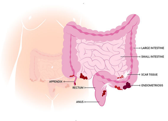 bladder endometriosis: