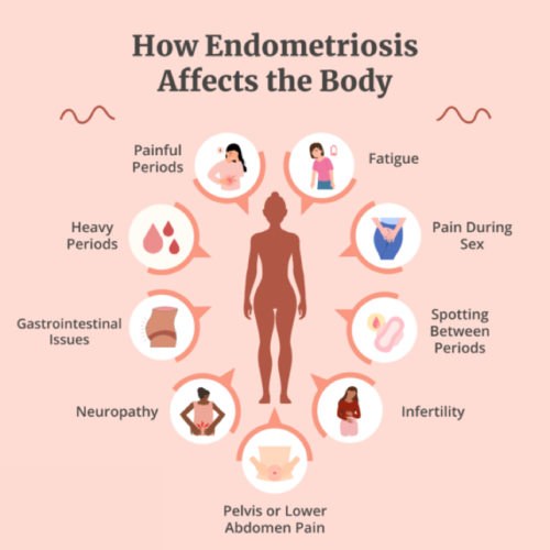 Symptoms_of_Endometriosis