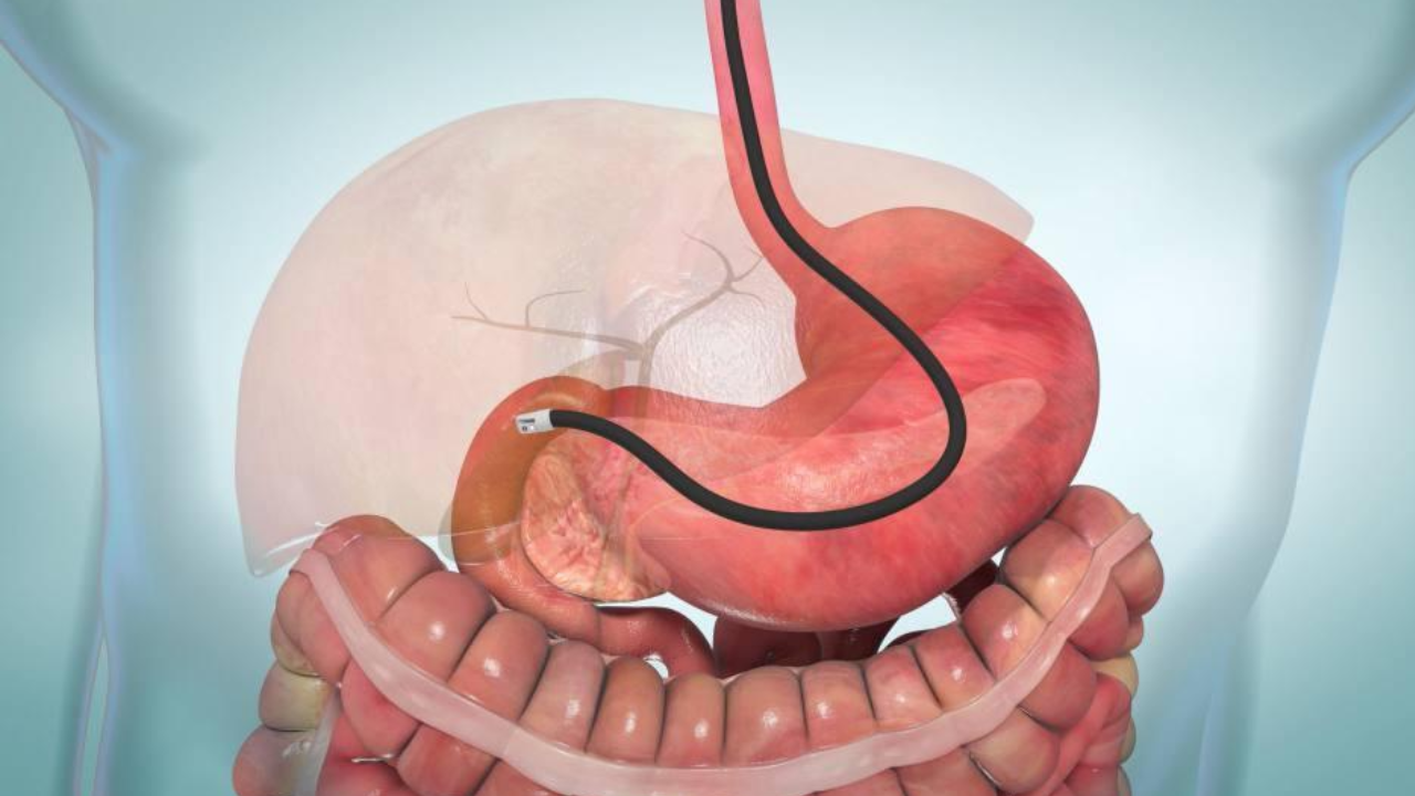 endoscopic-retrograde-cholangiopancreatography