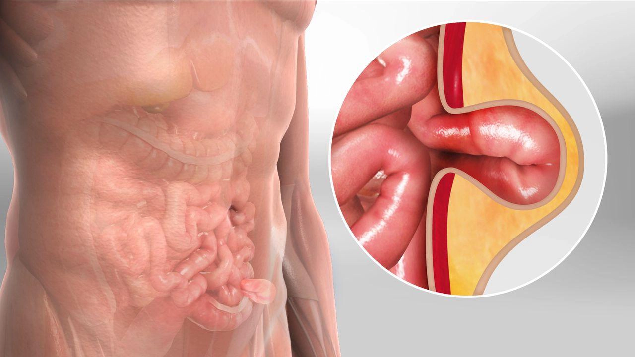 hernia-surgery-in-coimbatore-chennai