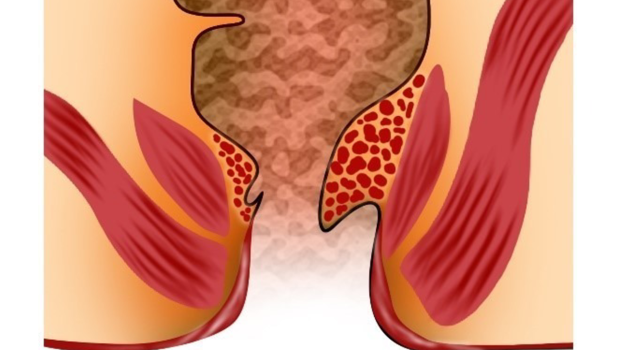 incision-and-drainage-piles-treatments