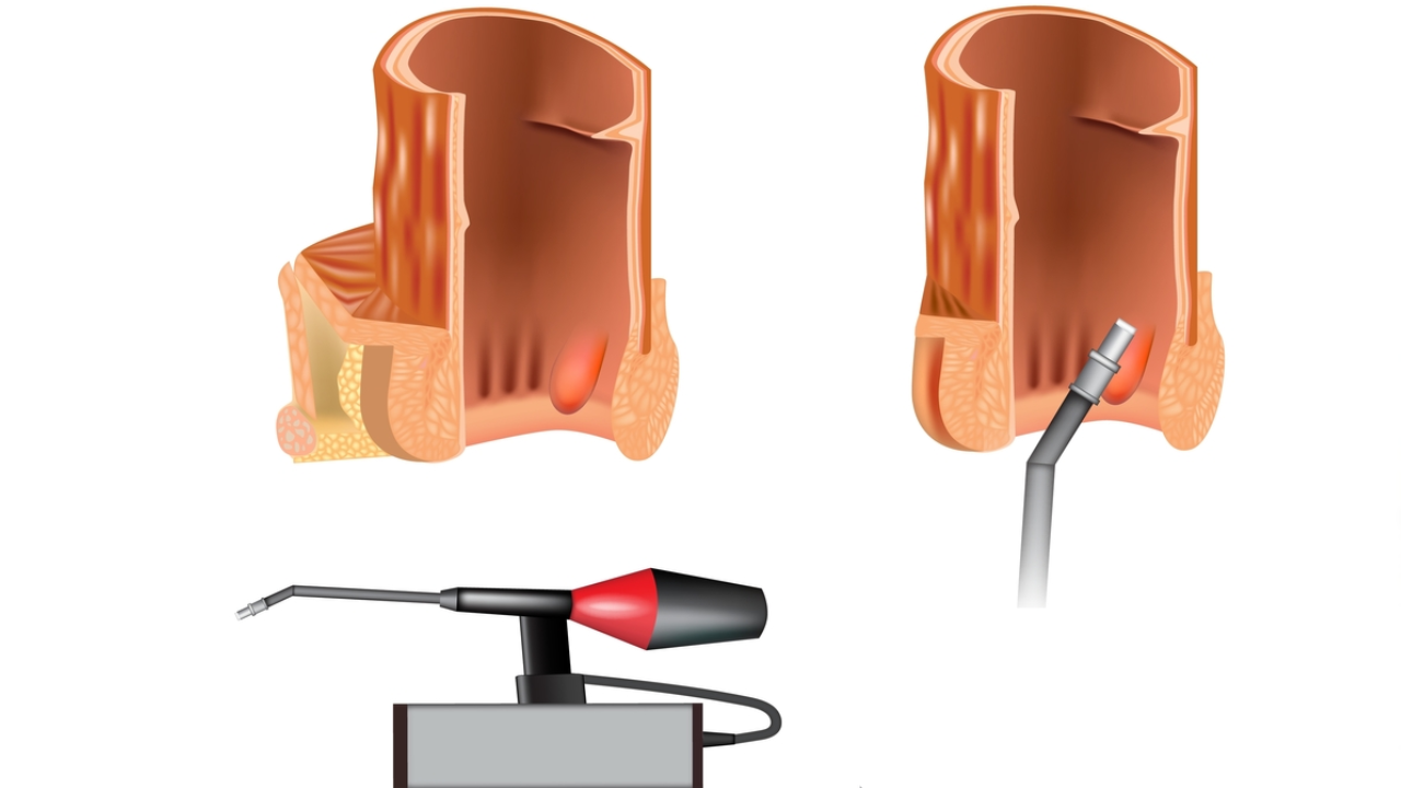infrared-coagulation-piles-treatments