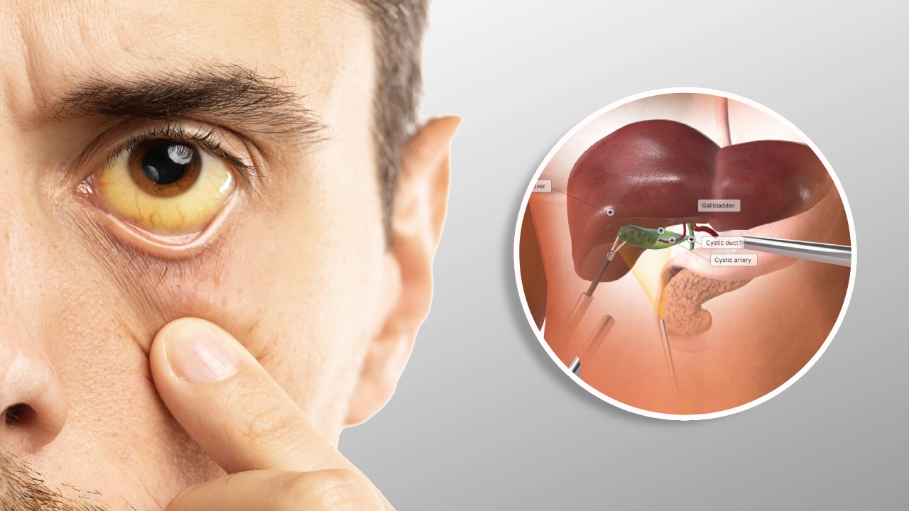 jaundice-treatment-in-coimbatore-chennai