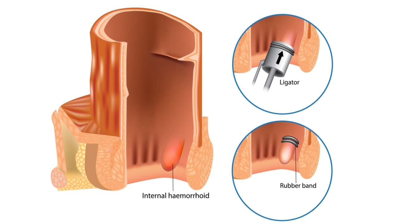 rubber-band-ligation-piles-treatments