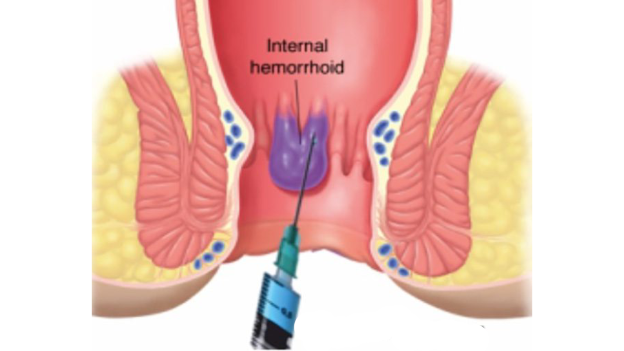 sclerotherapy-piles-treatments
