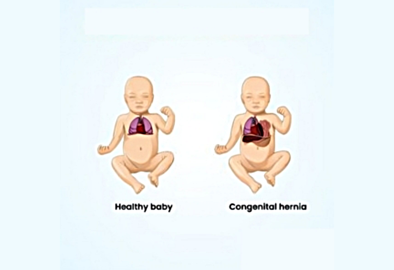 hernia-surgery-in-coimbatore-chennai