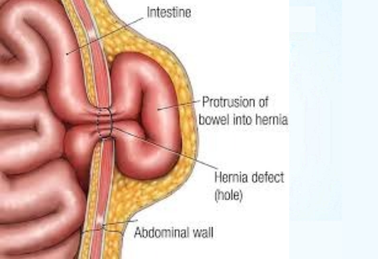 hernia-surgery-in-coimbatore-chennai