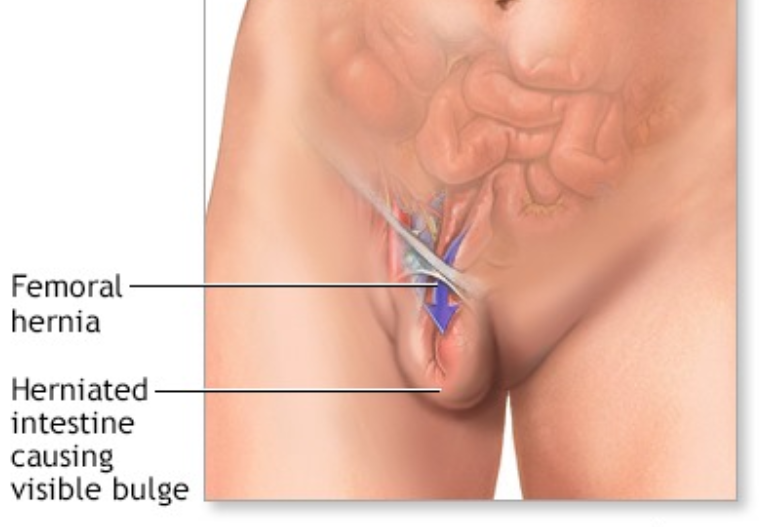 hernia-surgery-in-coimbatore-chennai