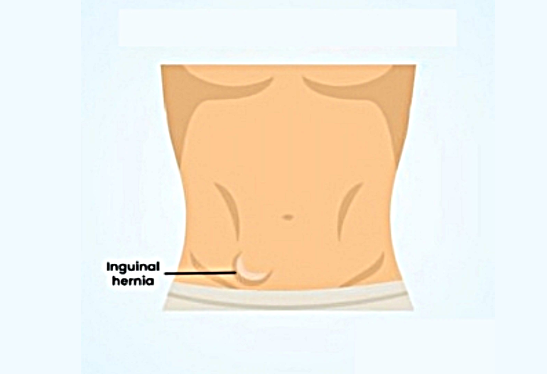 hernia-surgery-in-coimbatore-chennai
