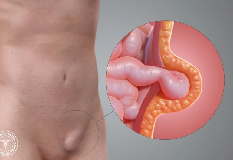 hernia-surgery-in-coimbatore-chennai