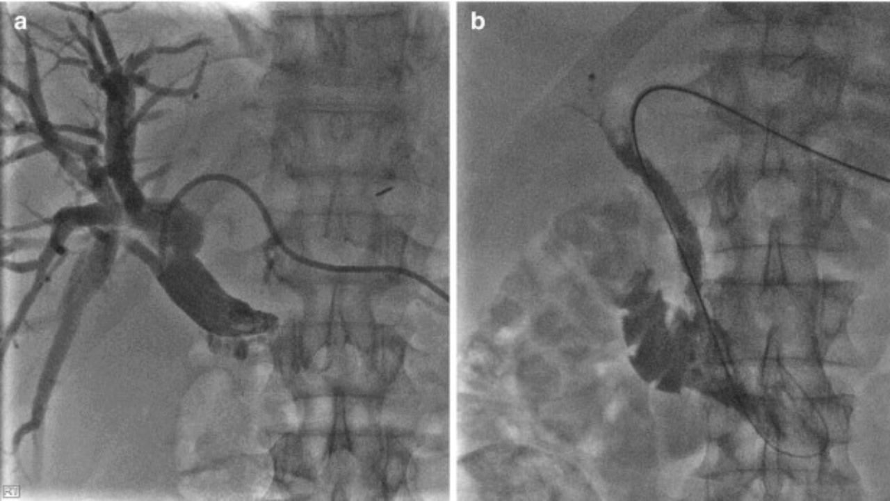 percutaneous-transhepatic-cholangiography