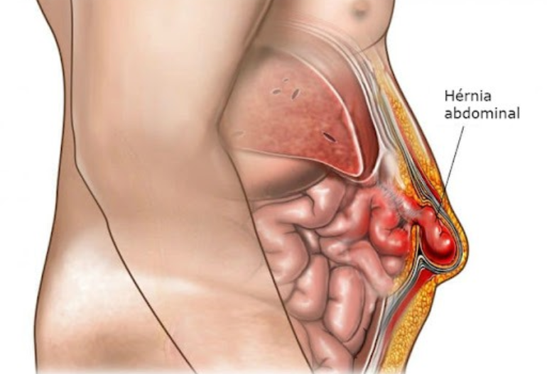 hernia-surgery-in-coimbatore-chennai