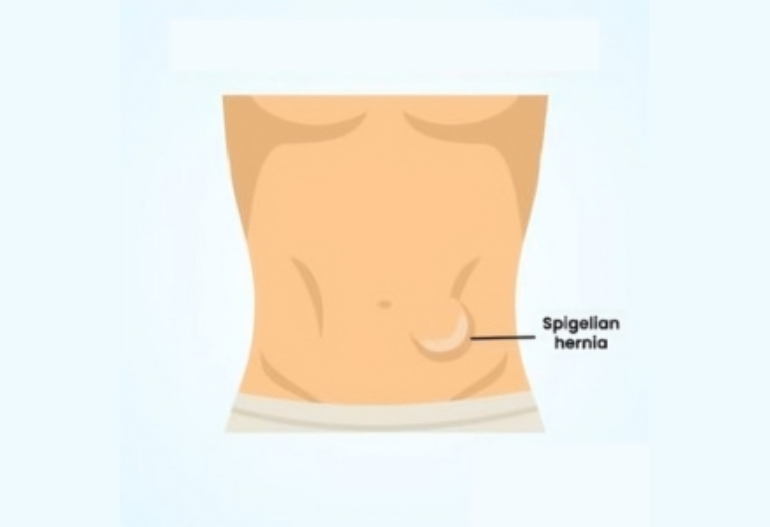 hernia-surgery-in-coimbatore-chennai