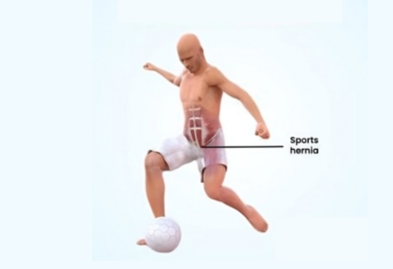 hernia-surgery-in-coimbatore-chennai