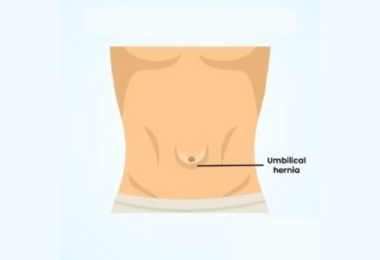 hernia-surgery-in-coimbatore-chennai
